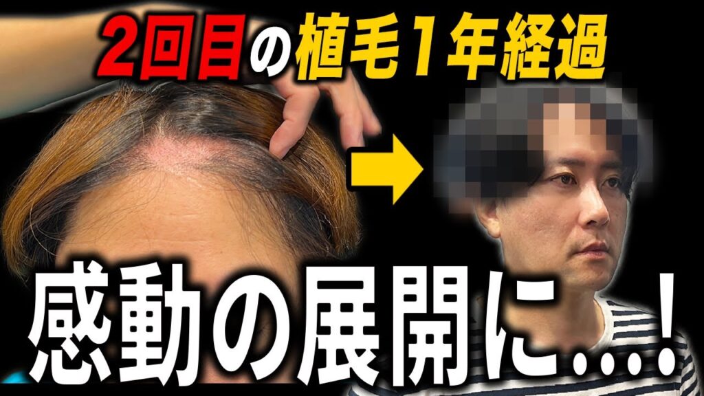 【大感動】理想を求めて2回の植毛をした40代メンズの想いとは...?