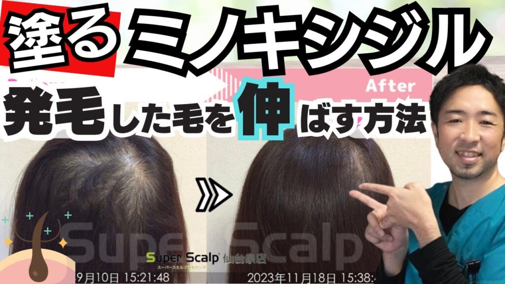 【女性の発毛】ミノキシジル外用薬で生えた短い毛を育毛して薄毛改善させる方法。お勧めの育毛剤やシャンプーの成分を紹介