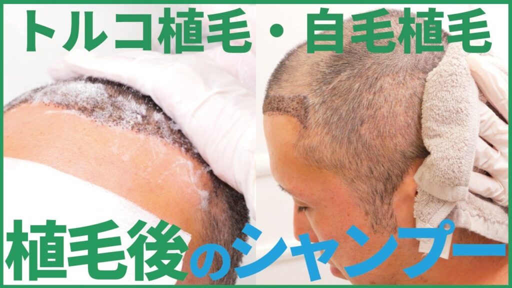 【トルコ植毛・自毛植毛】植毛手術後のシャンプー方法