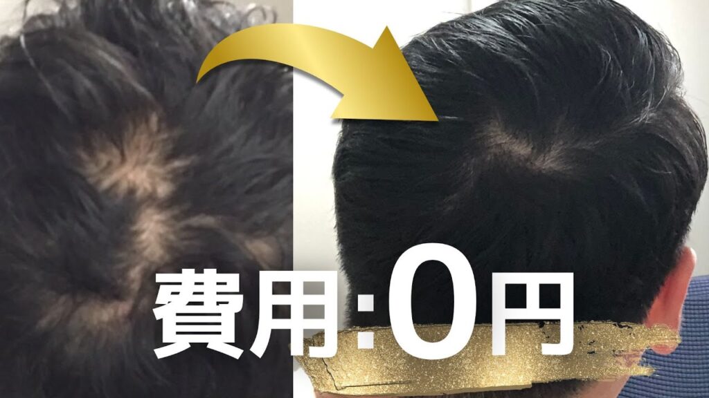 【0円増毛】ガチで薄毛が治った習慣「2選」【薄毛で悩んでる方へ】