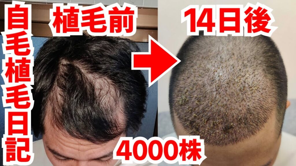 【自毛植毛日記2】トルコ自毛植毛〜2週間後の経過【4000株】