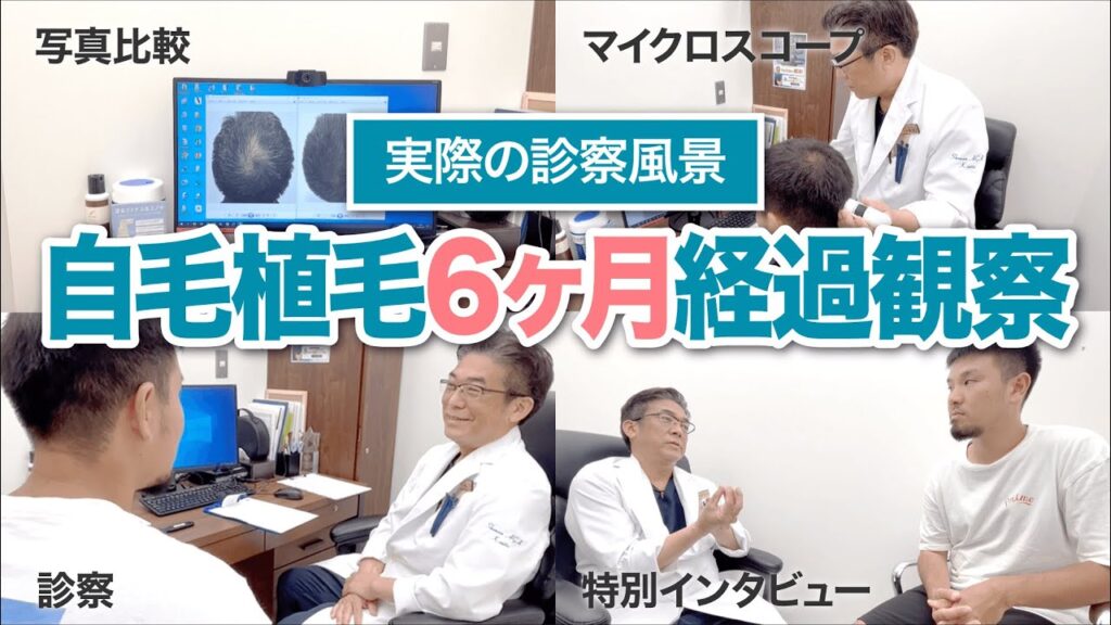 頭頂部へ自毛植毛した方の6ヶ月目を診察しました【特別インタビュー付き】