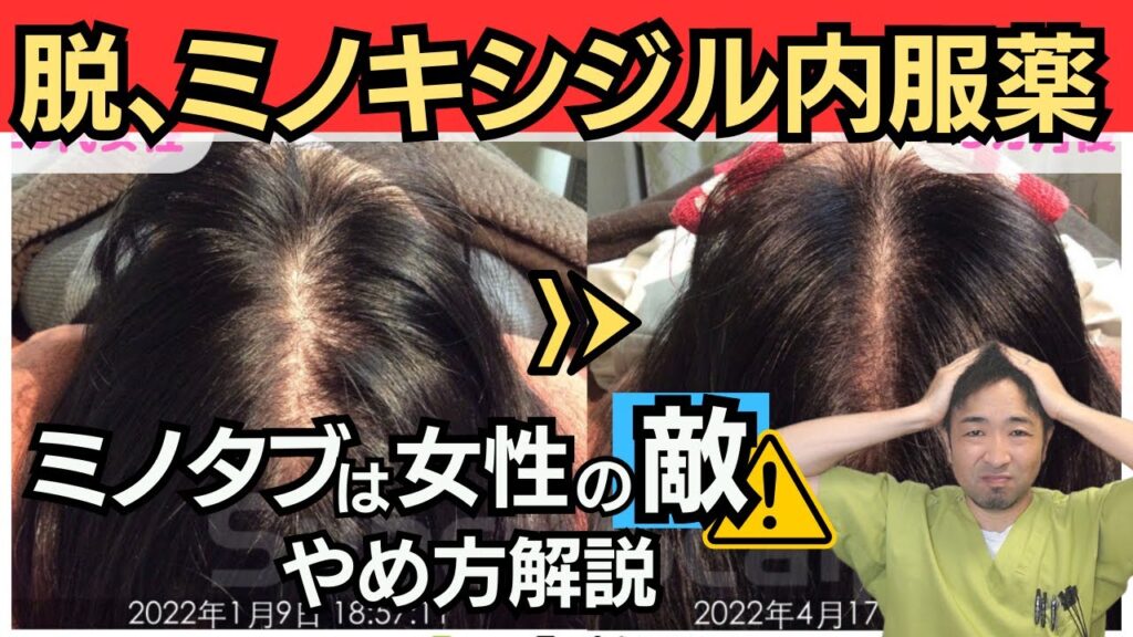 【飲んで後悔】女性がミノキシジル内服薬をやめて発毛した方法（発毛剤なし）