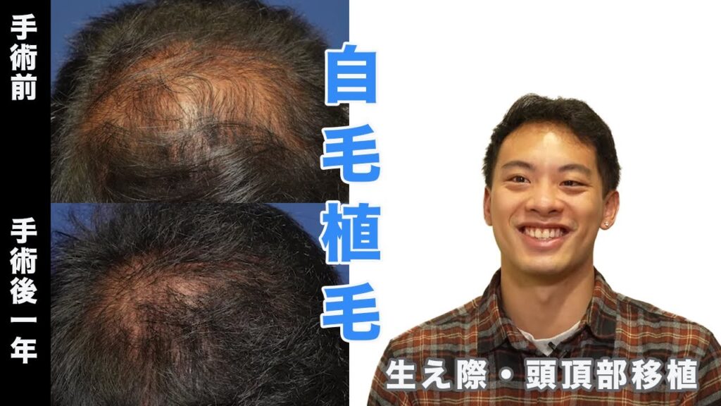 【植毛1年後】生え際・頭頂部2500株移植された体験者様へお話を伺いました。【自毛植毛】【植毛】