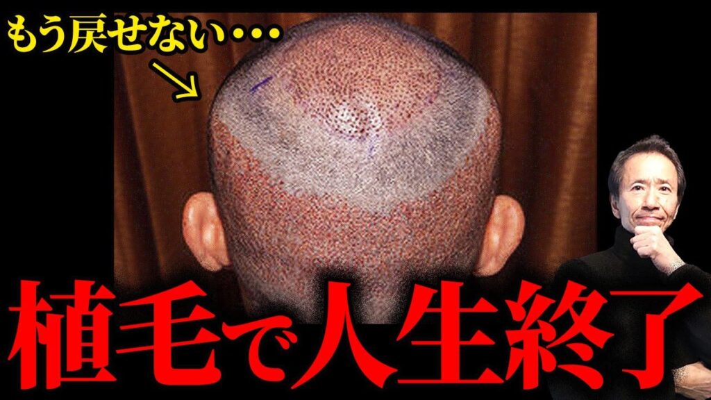 【注意】植毛で大失敗する前に見て！