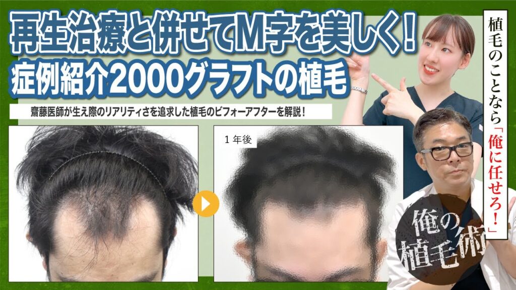 【俺の植毛術】再生治療の併用でM字のラインを美しく！2000グラフトの植毛症例ビフォーアフターを紹介します！