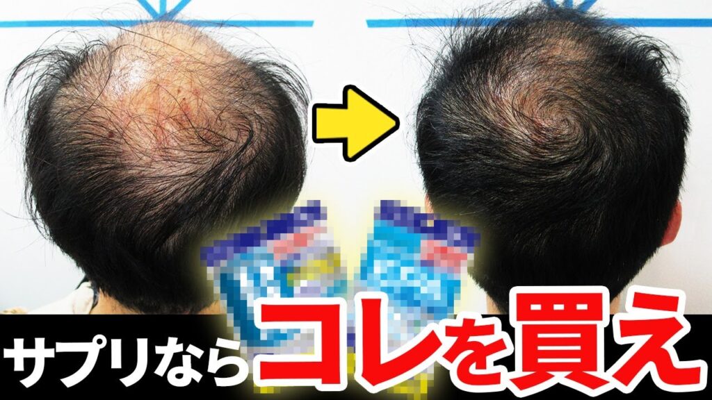 【プロが厳選】コンビニで買える！育毛サプリメント3選【薄毛改善】