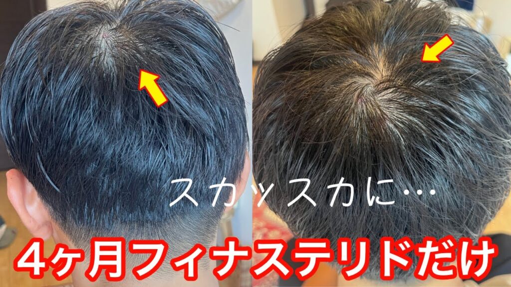 【AGA治療】フィナステリド1mgだけで薄毛治療したらハゲが進行しました。