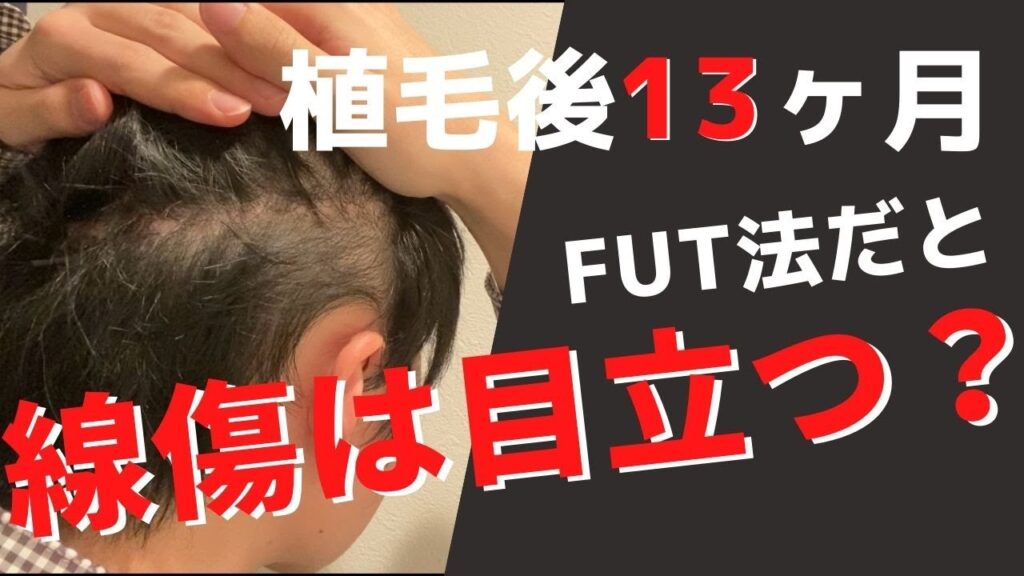 【悲惨?】植毛したら後頭部の傷は目立つのか?術後13ヶ月経過時点で観察