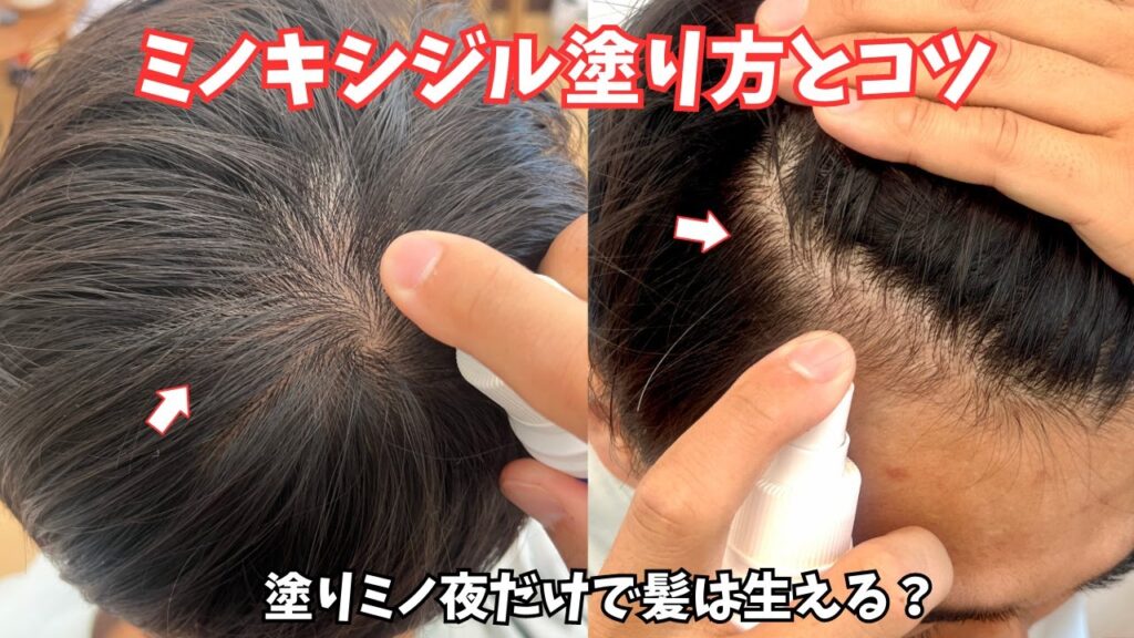 ミノキシジルの塗り方とコツ💡塗りミノ夜1回だけで薄毛は治せるのか？