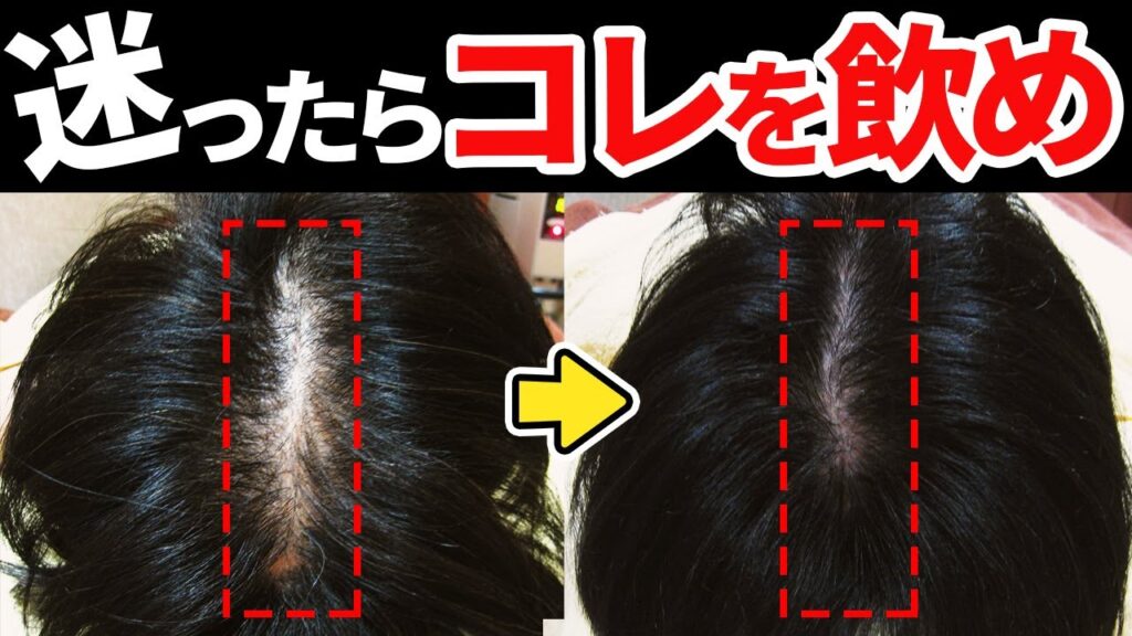 【薄毛対策】発毛のプロがオススメする亜鉛サプリメント2選!