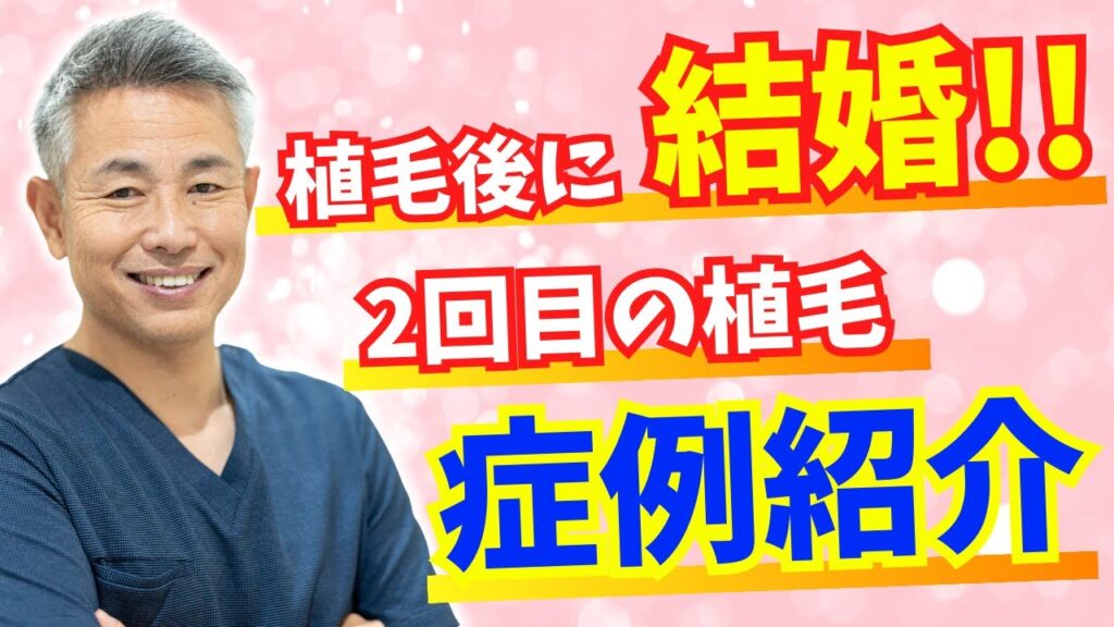【植毛後に結婚】2回目オペ症例の1年半後の経過