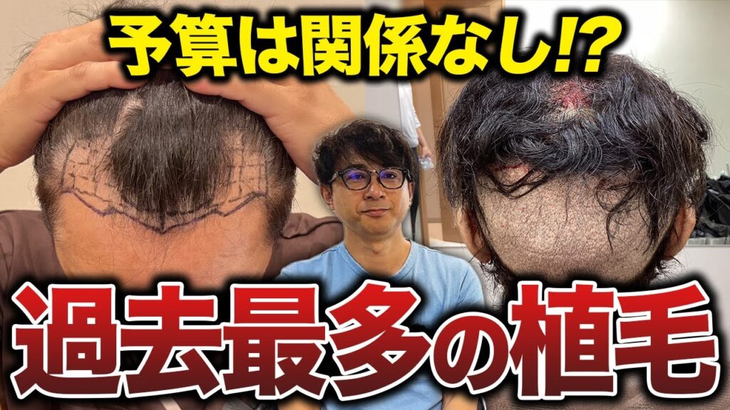 【自毛植毛】過去最多の3000グラフト移植!40代メンズの植毛手術に完全密着!