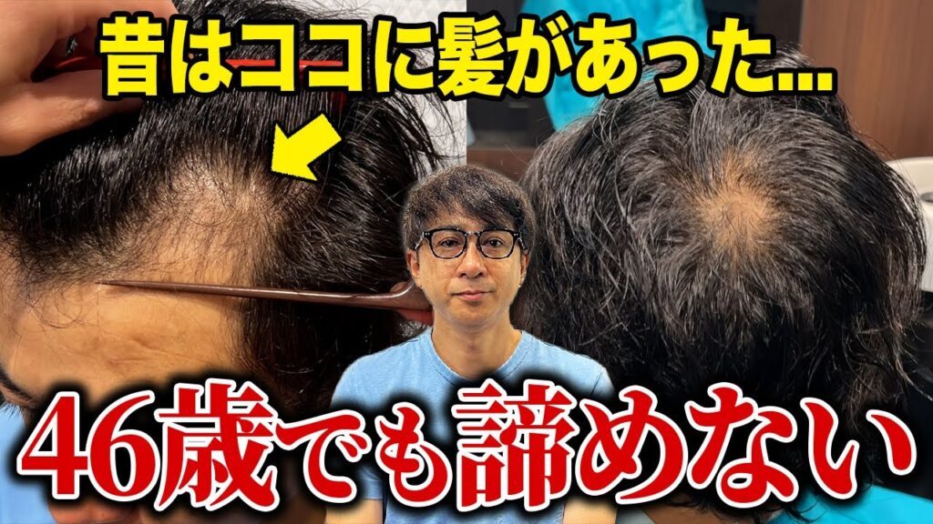 【初登場】20代で生え際が後退、自信がみるみる消えた男性が植毛に挑戦!
