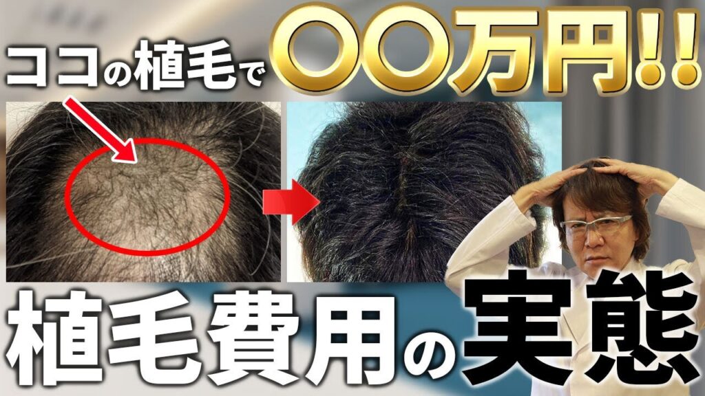 【保存版】意外と知らない植毛治療の金額を現クリニック医師が解説！【自毛植毛／薄毛／AGA】