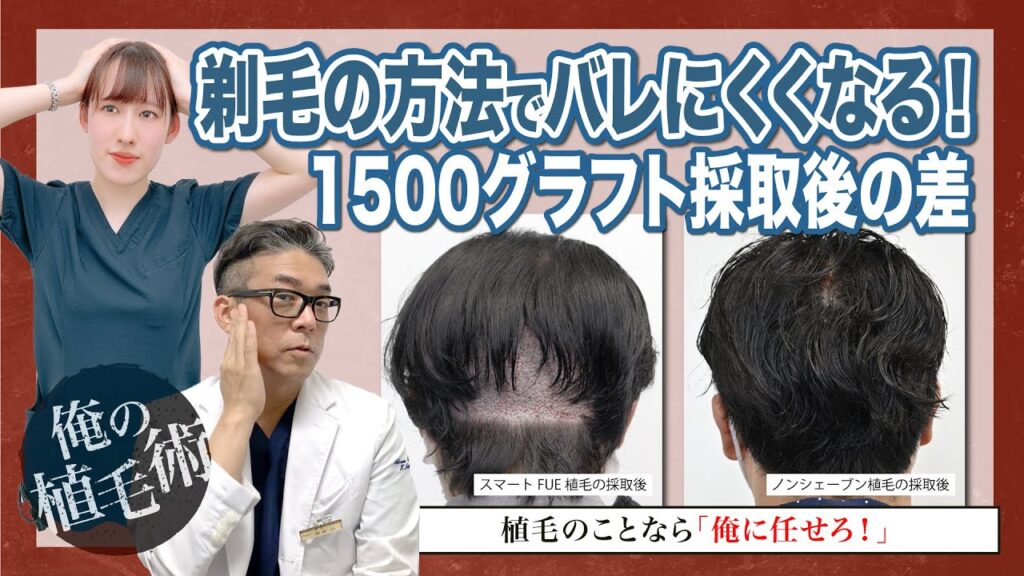 【俺の植毛術】自毛植毛ってバレる？バレない？剃毛方法でバレにくくなる？