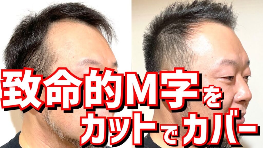 【前髪の薄毛】致命的M字ハゲをカットのみでカバー