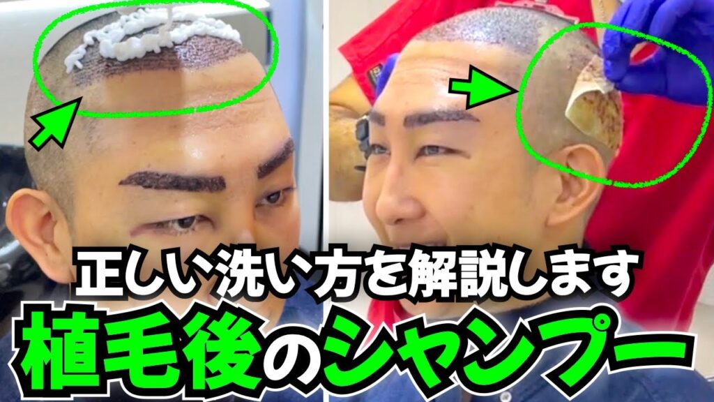 【洗い方】自毛植毛 シャンプーの仕方を解説します【AGA｜薄毛治療｜ハゲ対策｜髪の毛】