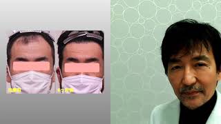 46歳男性　ハミルトン・ノーウッド分類タイプiV自毛植毛1,500グラフトとダブルマトリックス 　半年後の経過写真