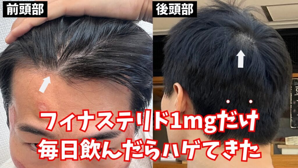 【4ヶ月】フィナステリド1mgだけ毎日飲んだらハゲてきました【薄毛・AGA治療経過報告】