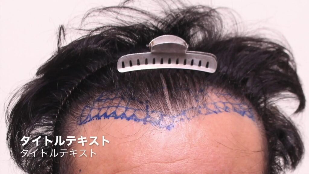 植毛の経過と効果　手術１週間後　湘南美容外科AGAルネッサンスクリニック