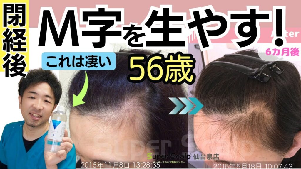 【56歳女性M字の薄毛改善】女性ホルモンに囚われない飲み薬無しの薄毛改善法3選