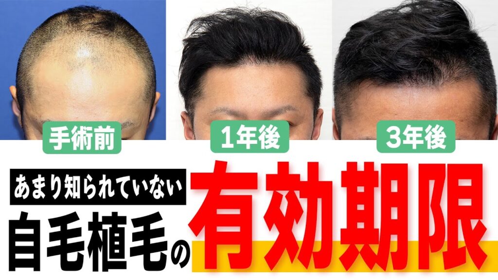 【自毛植毛】手術から3年以上経過するとどうなるのか？【薄毛】【AGA】