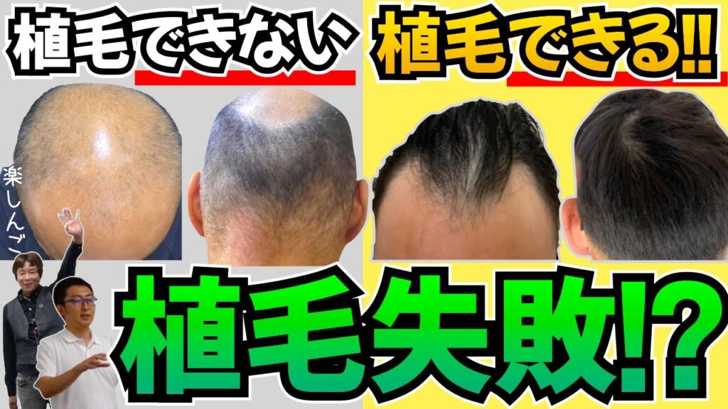 【植毛失敗】植毛しない方がいい頭、植毛が向いてる頭を解説します【薄毛の窓口|楽しんご|いしだ壱成】