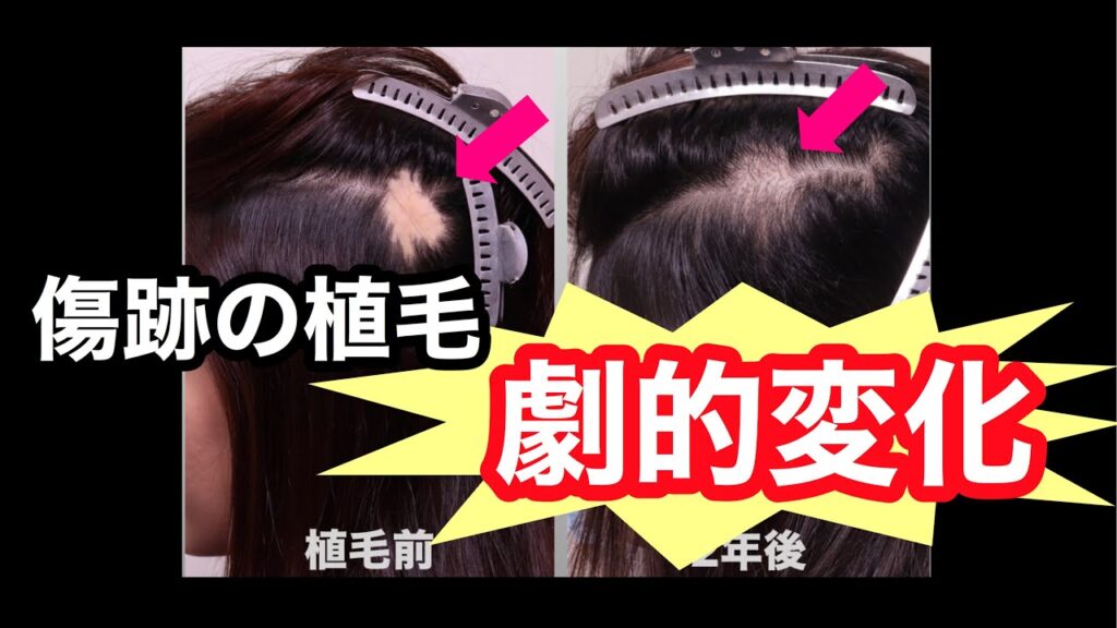 頭部傷痕の治療に自毛植毛とダブルマトリックス複合治療　オンライン植毛の湘南AGAクリニック新宿南口院↓ライン友達登録で無料オンラインカウンセリング　https://lin.ee/lUlwses