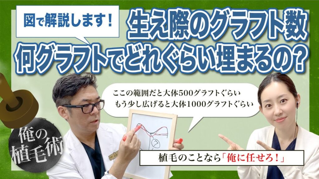 【俺の植毛術】グラフト数別、どれぐらい埋まるの？【自毛植毛】