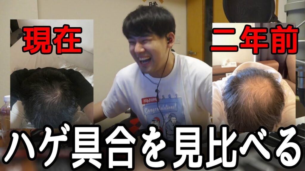 過去と現在のハゲ具合を見比べ笑うゆゆうた【2022/07/10】