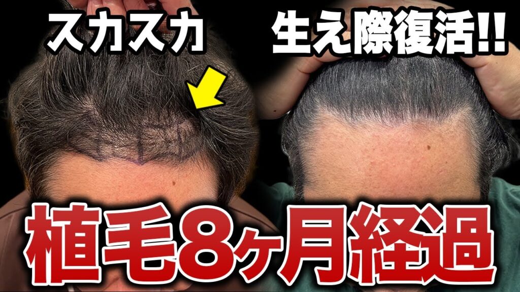 【40代薄毛】植毛8ヶ月で後退していた生え際がきれいに復活!!