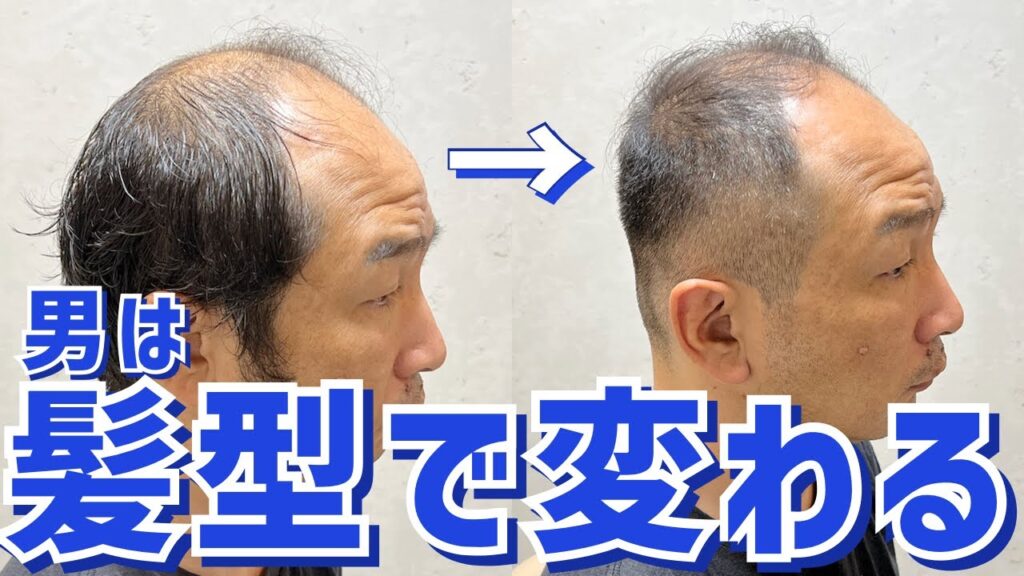 【薄毛】頭頂部はげがベリーショートで大変身‼︎