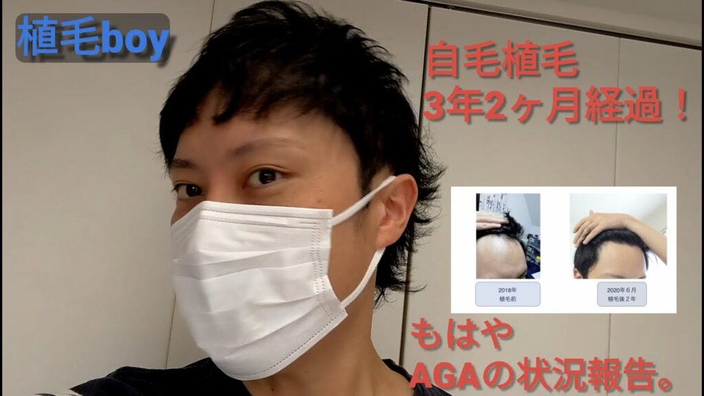 自毛植毛3年2ヶ月経過!フィナはどうする?アスク井上クリニック