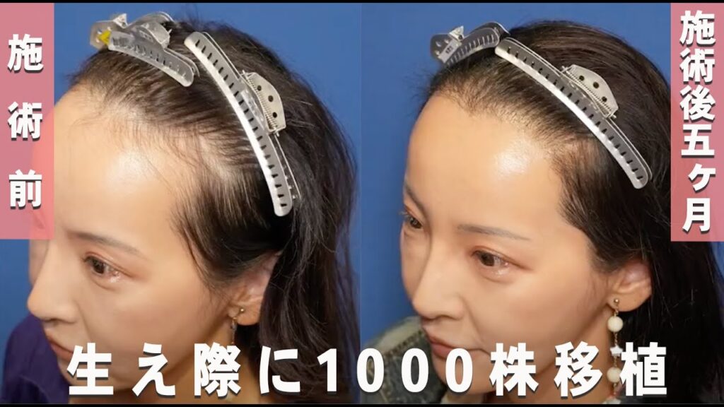 【植毛5ヶ月後 生え始め 】ヘアラインに1000株移植 施術から5ヶ月を追う【自毛植毛】【植毛】【女性 薄毛】