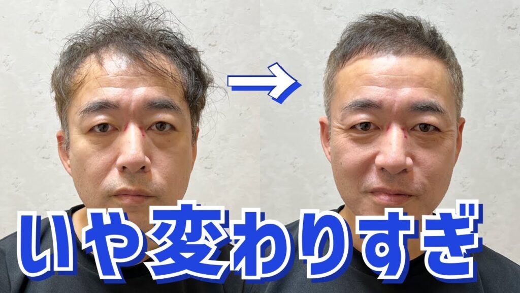 【薄毛】M字ハゲを目立たせないカット術