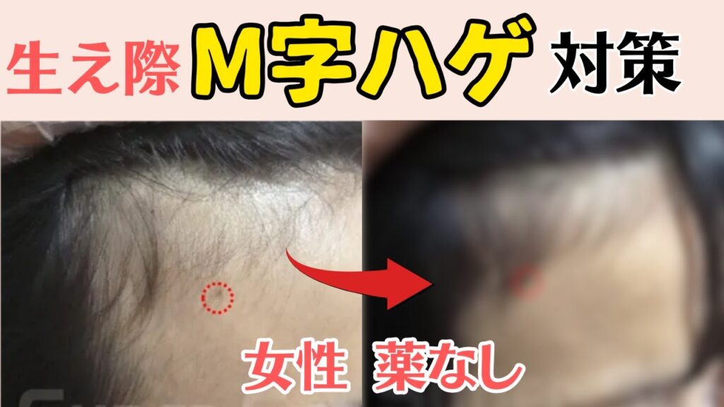 【女性の生え際】後退したM字ハゲを治す方法を発毛症例で解説