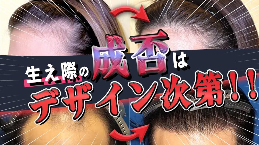 【自毛植毛】理想の生え際を手に入れる！！【植毛】【薄毛】