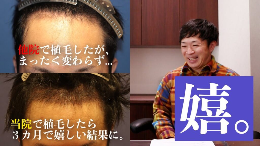 【植毛3ヶ月後 生え始め】実際に自毛植毛を受けられた体験者様にお話を聞きました!【植毛】【薄毛治療】