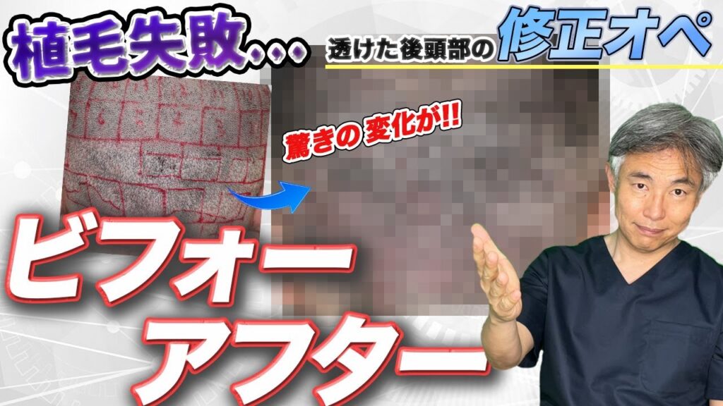 【悲劇】他院で後頭部の採取に失敗！修正オペについて解説します