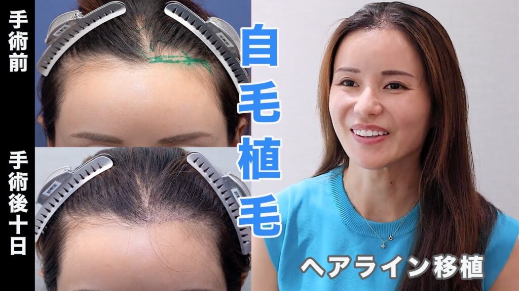 【自毛植毛10日後】ヘアラインの自毛植毛を受けられた藤井先生へインタビューしました【植毛】【薄毛治療】