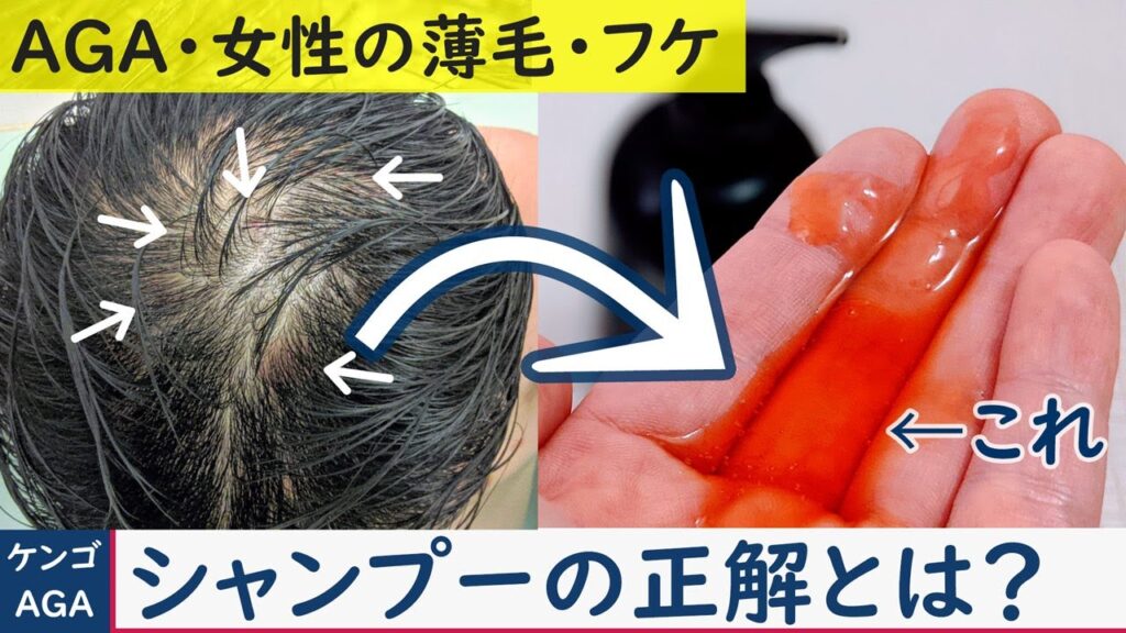 科学的根拠があるAGA治療に有効なシャンプーとは?【湯シャン・育毛シャンプー・女性の薄毛治療】