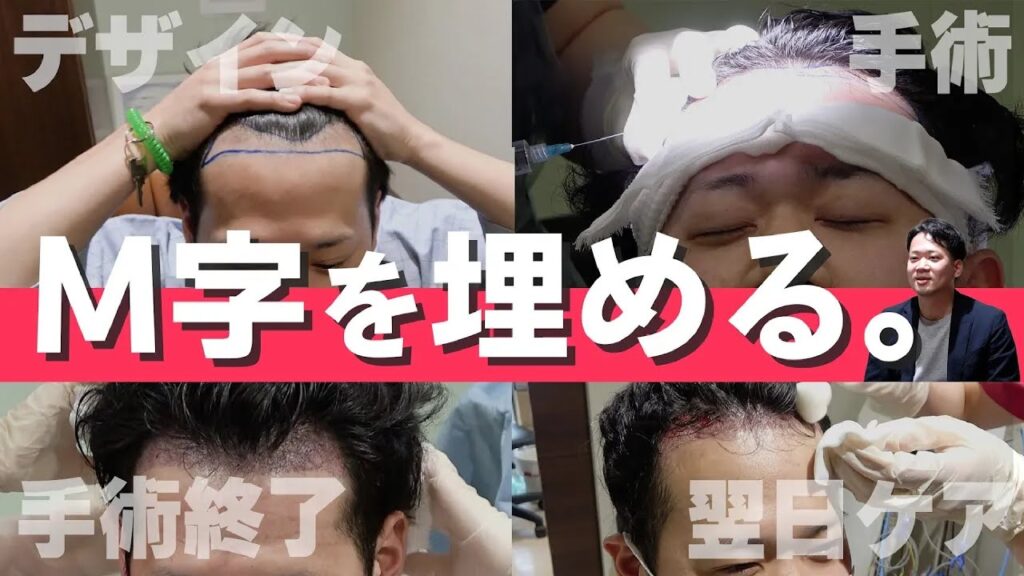 【自毛植毛】M字ハゲに悩む30代男性の自毛植毛手術当日に密着！【植毛】【薄毛治療】