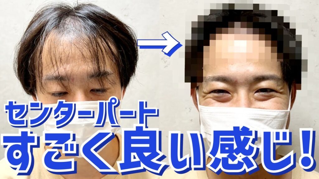 【M字ハゲ】センターパートで薄毛をカバーするセット術