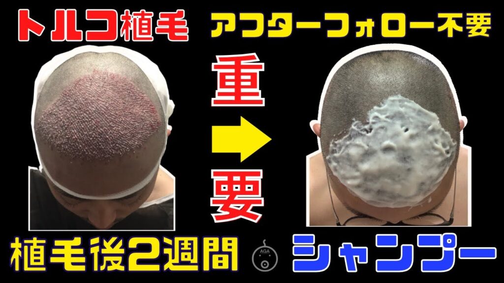 【２週間が重要】トルコ植毛後のシャンプー【植毛費70万】