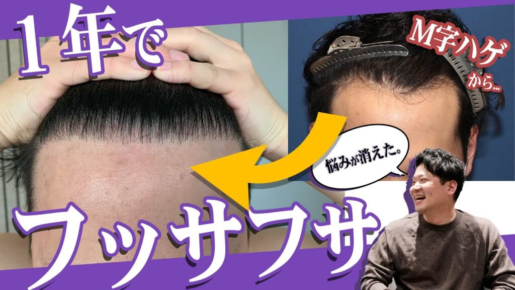 【自毛植毛】M字ハゲの悩みが解消！手術から1年が経過した30代男性の現在をインタビュー！【植毛】【薄毛治療】