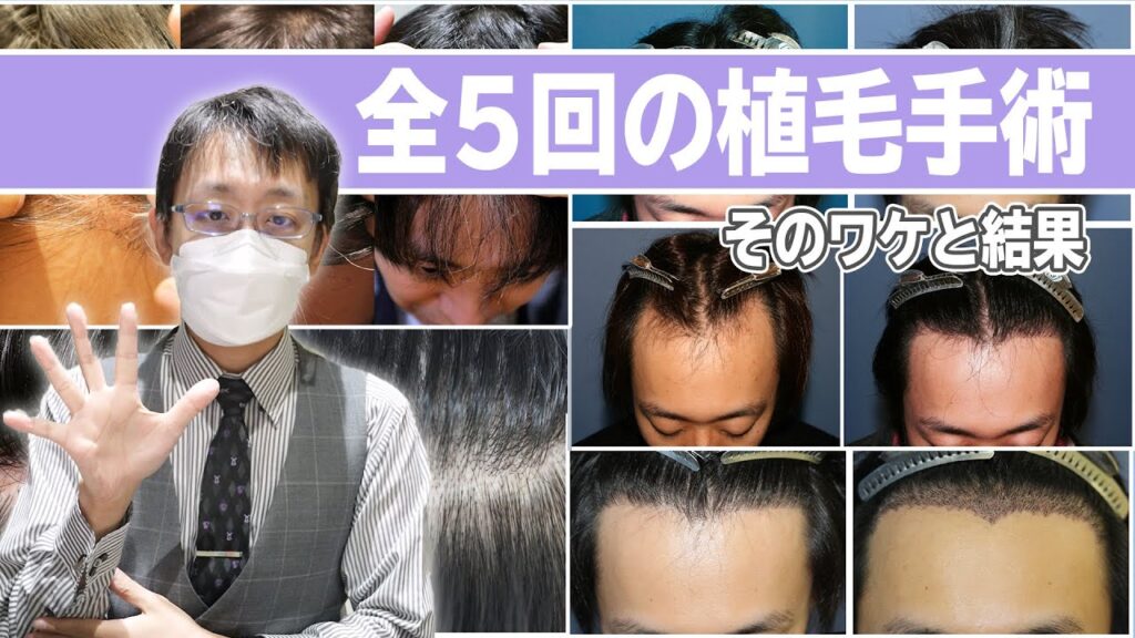 植毛手術 全5回の経緯、金額、結果についてご紹介いたします【自毛植毛】
