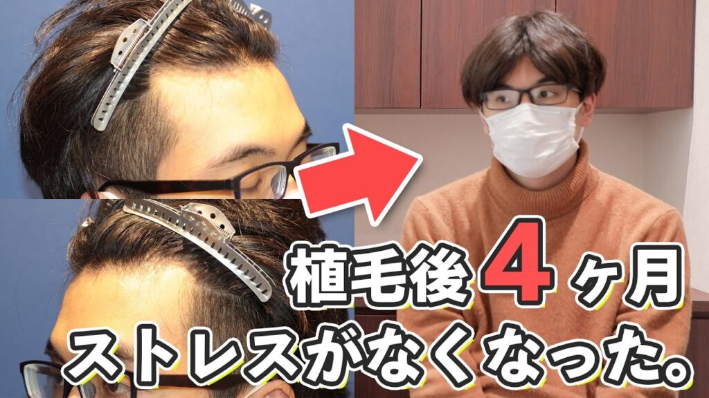 【自毛植毛】術後4ヶ月が経過された体験者様と対談させて頂きました！【植毛】【薄毛治療】