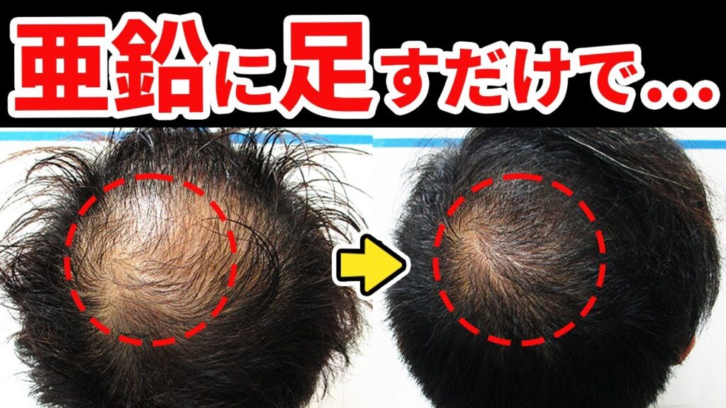 【発毛のプロが推奨】亜鉛に足すと効果倍増する薄毛改善サプリを紹介【ノコギリヤシ】
