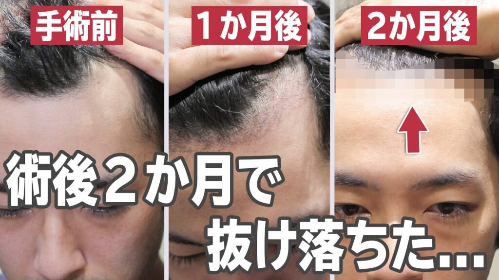 【植毛 手術】モニター患者様の術後2ヶ月経過を伺いました【自毛植毛】